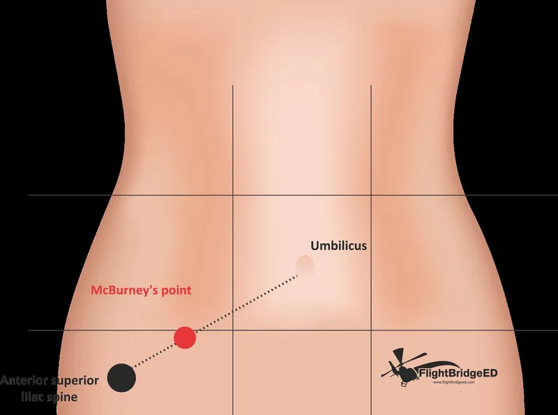 McBurney's point location