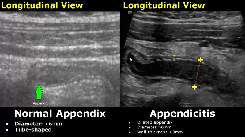 Ultrasound: Normal vs. Appendicitis