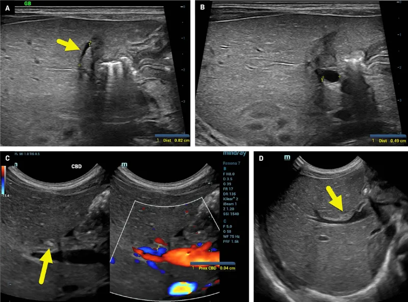Ultrasound findings in biliary atresia