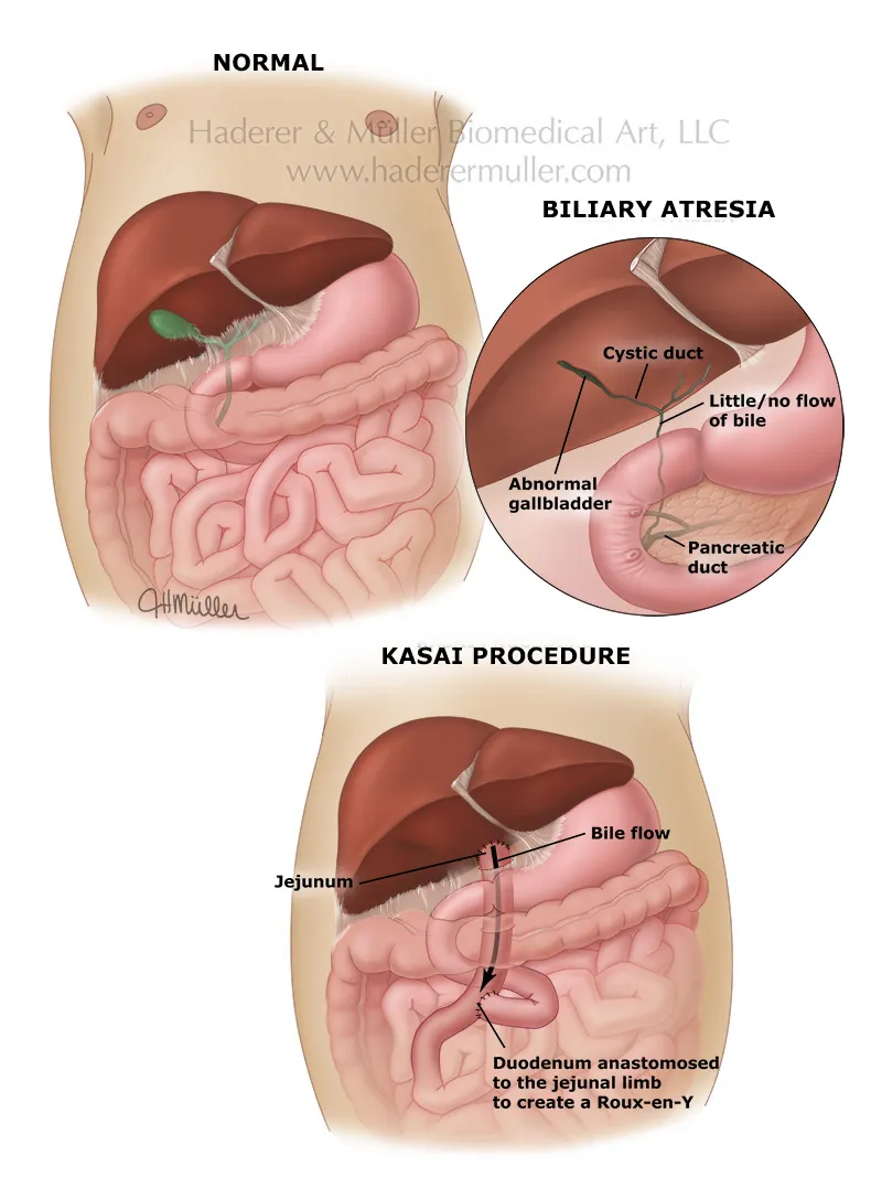 Biliary Atresia and Kasai Procedure Diagram