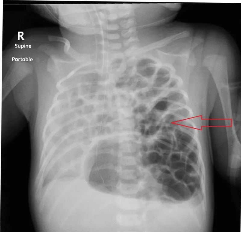 Chest X-ray: Congenital Diaphragmatic Hernia