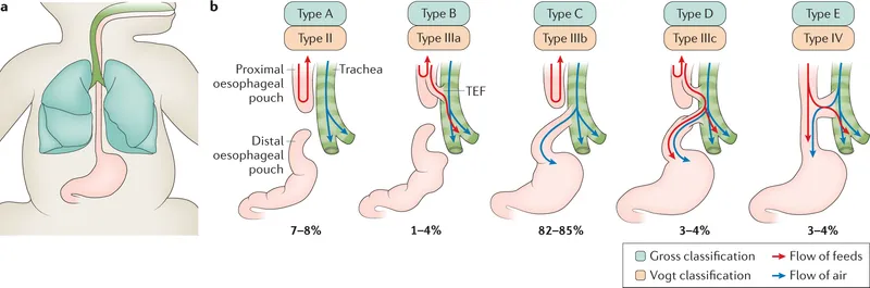 Types of Esophageal Atresia and TEF