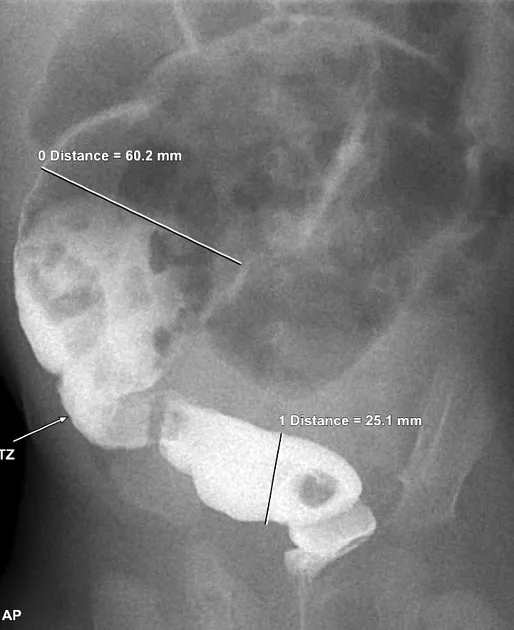 Hirschsprung's: Contrast enema with transition zone