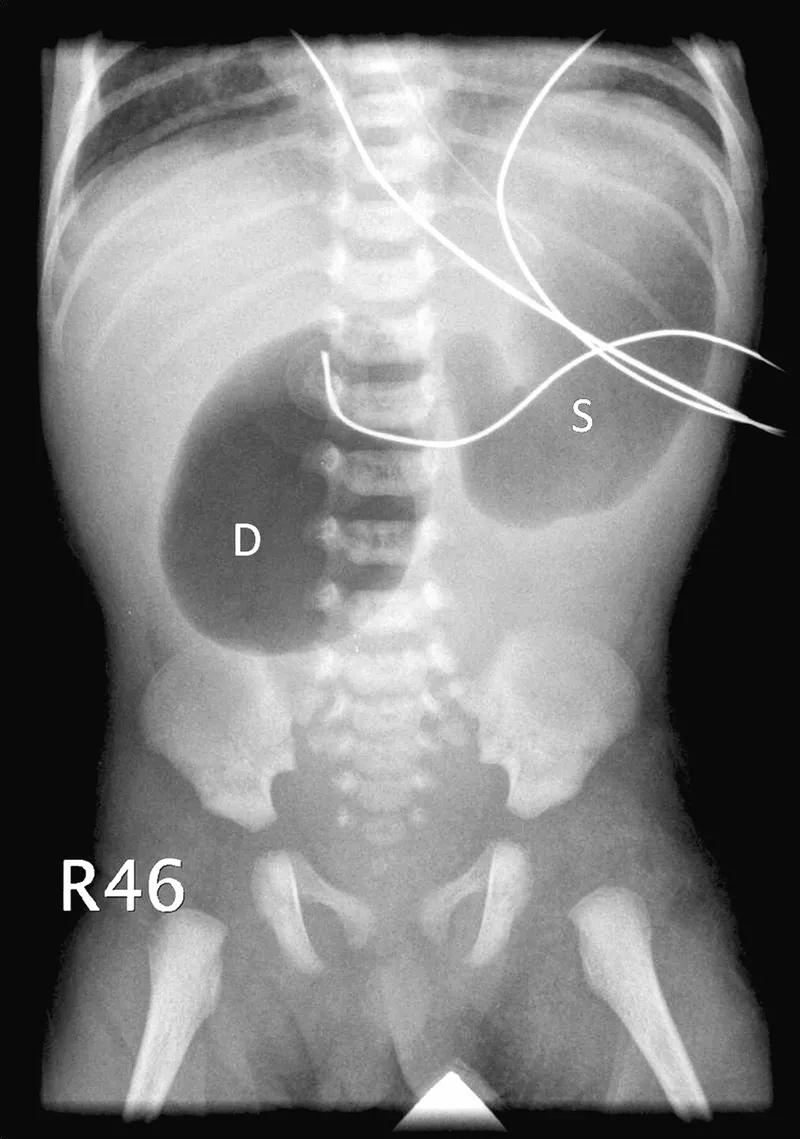 X-ray: Double bubble sign in duodenal atresia