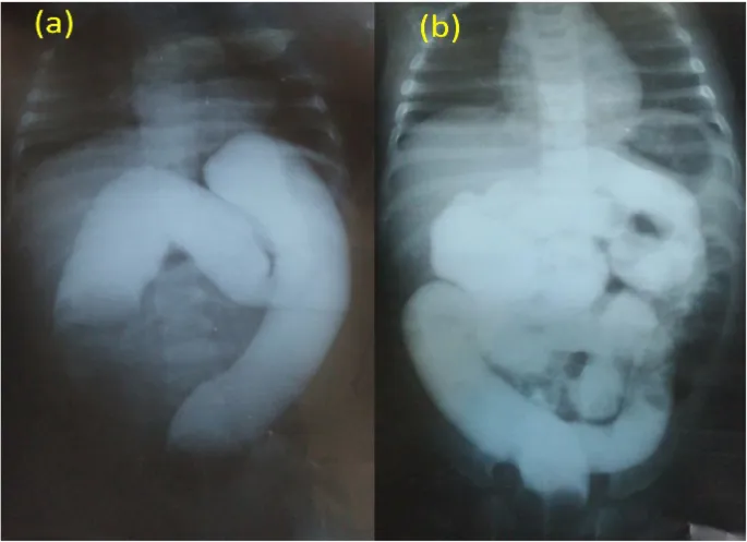 Intussusception reduction via enema: Before/After