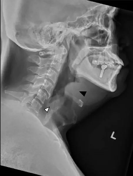 Lateral neck X-ray: Epiglottitis with thumb sign