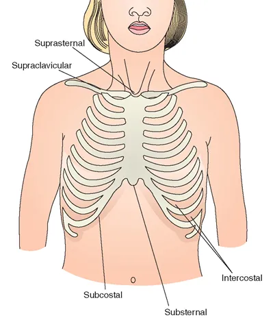 Pediatric Respiratory Retractions: Suprasternal, Intercostal