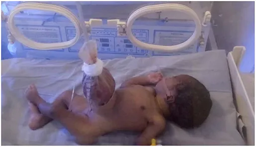 Neonate with omphalocele in sterile bowel bag