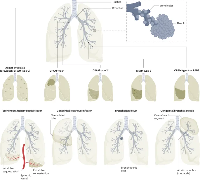 Congenital Lung Malformations: Types and Characteristics