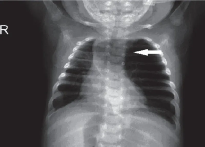 CXR: Congenital Lobar Emphysema with LUL hyperinflation