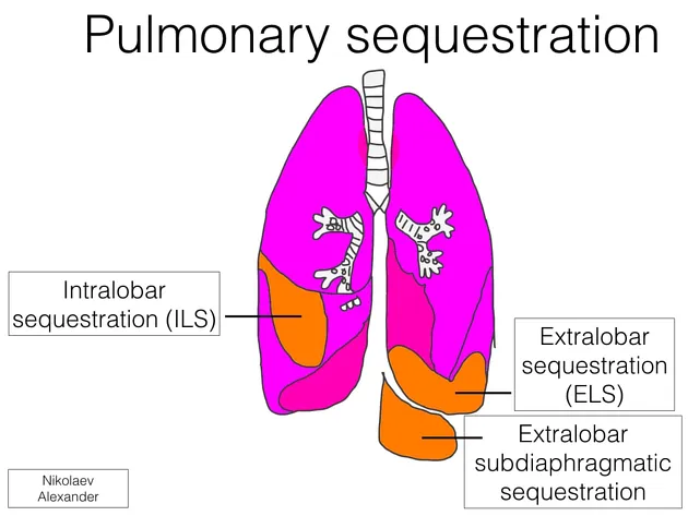 Pulmonary Sequestration Types: Intralobar and Extralobar