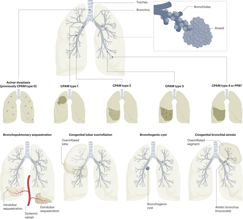 Congenital Lung Malformations: Types and Characteristics