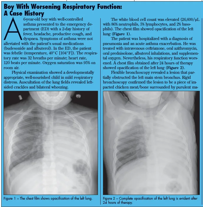 Chest X-rays of foreign body aspiration