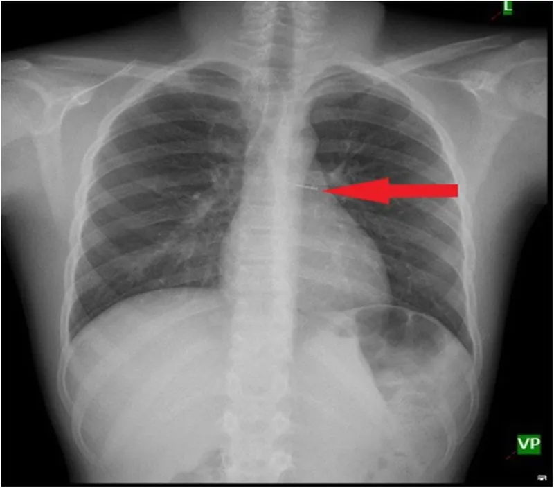 Chest X-ray: Foreign body aspiration