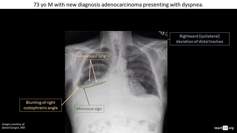 Chest X-ray: Pleural effusion with meniscus sign