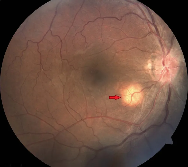 Fundoscopy: Choroidal Tubercles in Pediatric Miliary TB