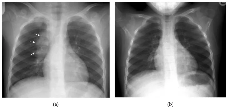 Pediatric TB Chest X-ray with hilar lymphadenopathy