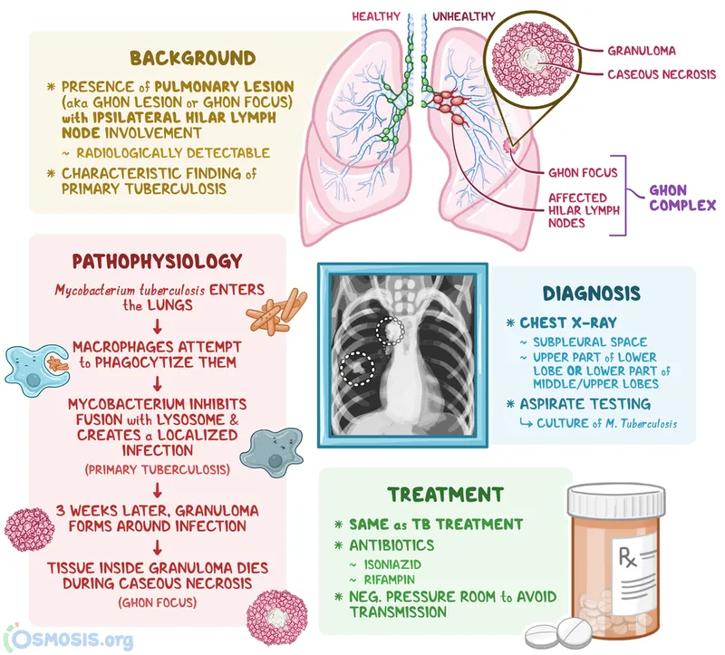 Ghon Complex in Primary Tuberculosis