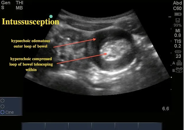 Ultrasound: Intussusception with target sign