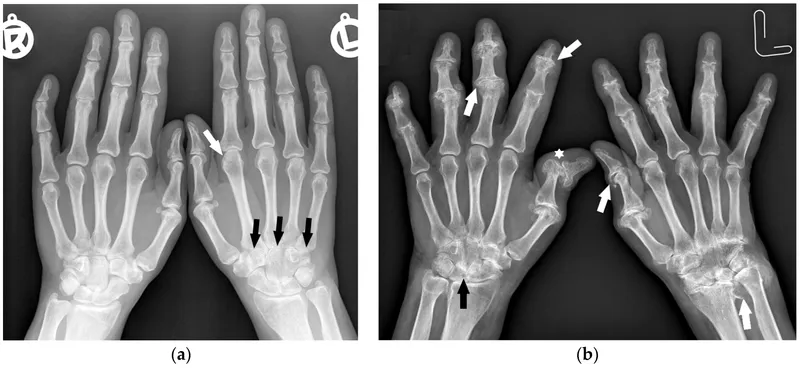 Radiograph of hands with rheumatoid arthritis