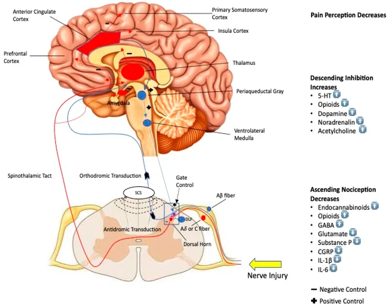 Neuropathic Pain Pathways and Spinal Cord Stimulation