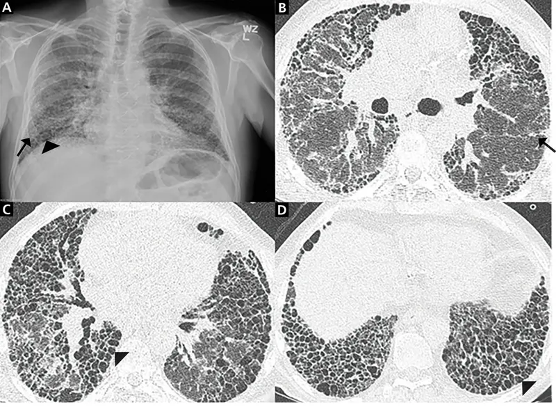 Bleomycin-induced pulmonary fibrosis on chest X-ray and CT