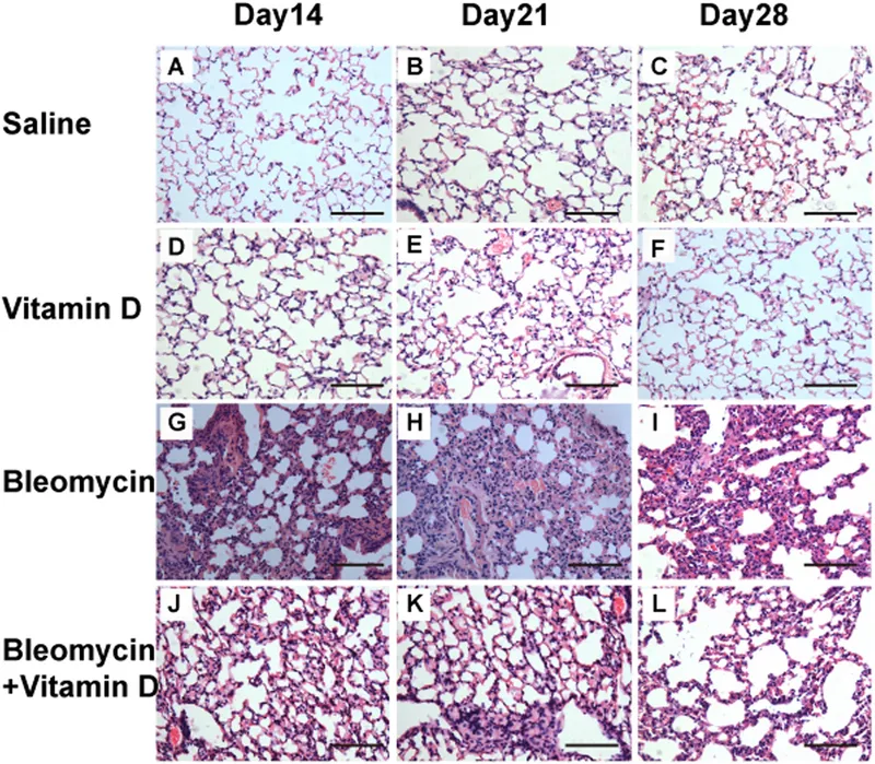 Bleomycin-induced pulmonary fibrosis and Vitamin D effect