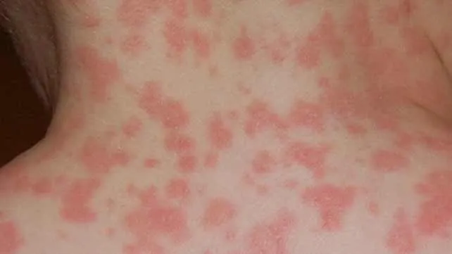 Maculopapular rash from penicillin allergy