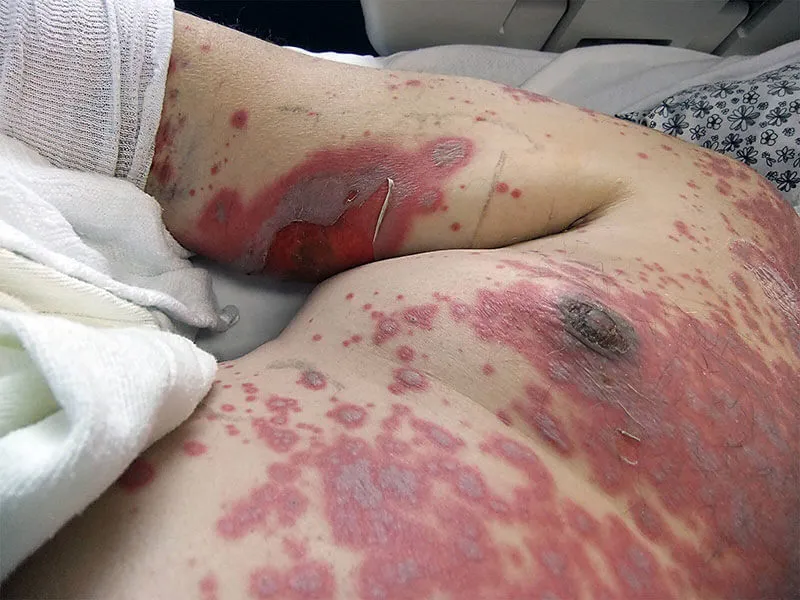 Stevens-Johnson Syndrome rash with blistering