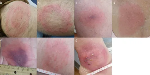 Erythema migrans rash variations in Lyme disease