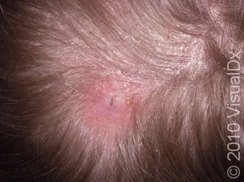 Tinea capitis with scaling and hair loss in a child