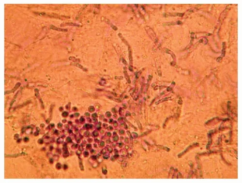 Malassezia globosa "spaghetti and meatballs" KOH prep