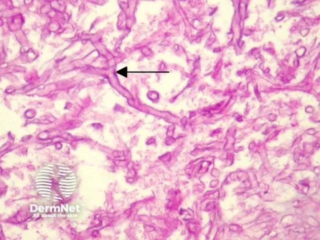 Mucormycosis: Broad non-septate hyphae at 90-degree angles