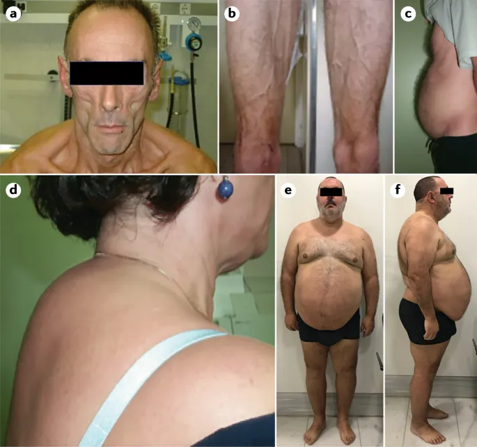 Lipodystrophy: facial thinning, buffalo hump, abdominal fat