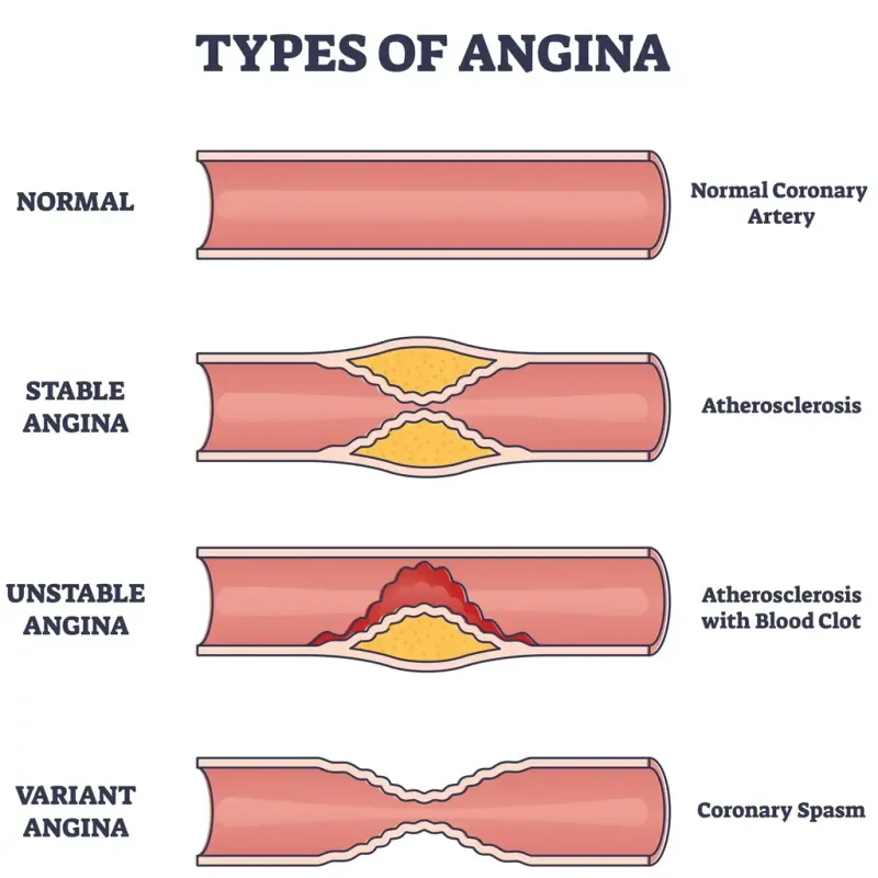 Types of Angina: Coronary Artery Changes