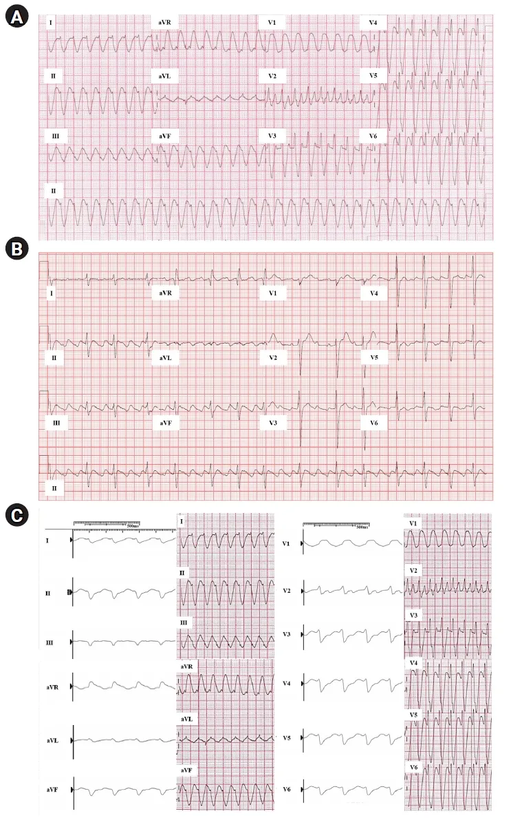ECG: QRS prolongation from Class IC antiarrhythmic
