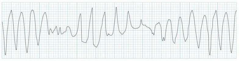 ECG strip showing Torsades de Pointes