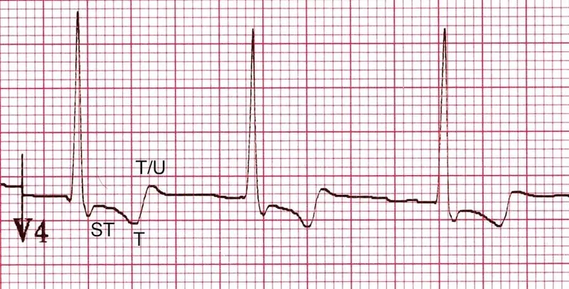 ECG: Digoxin effect with ST segment scooping