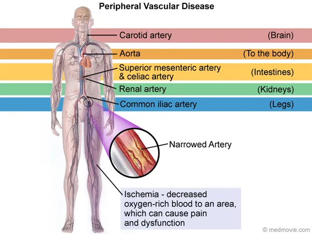 Peripheral vascular disease and ischemia