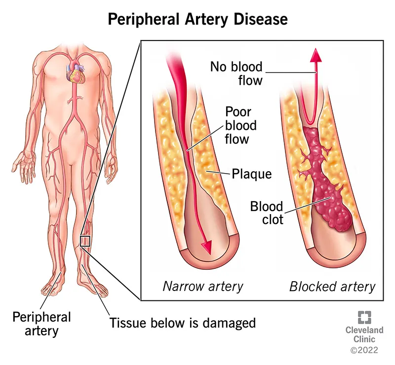 Peripheral Artery Disease: Narrowed and Blocked Artery