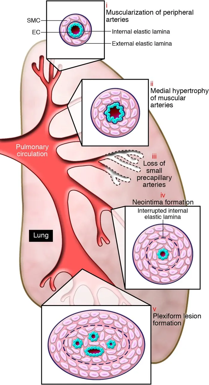 Pathological changes in pulmonary hypertension