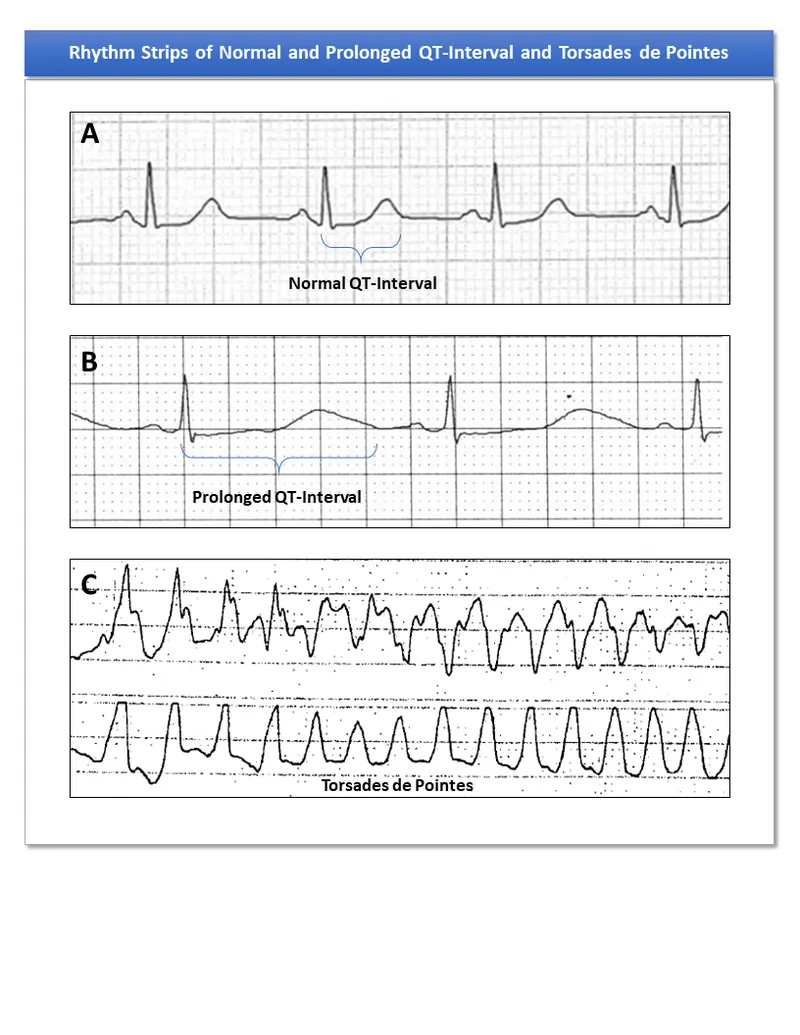 ECG: Normal, prolonged QT, and Torsades de Pointes