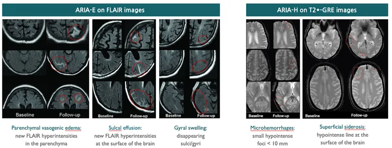 MRI showing ARIA from anti-amyloid Alzheimer's therapy