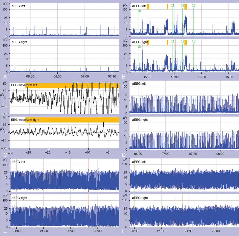cEEG showing burst suppression pattern