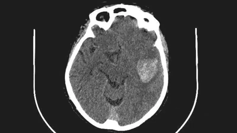Brain CT showing intracranial hemorrhage