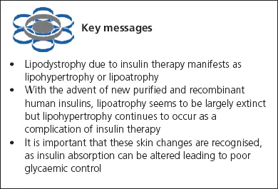 Key messages on lipodystrophy from insulin therapy