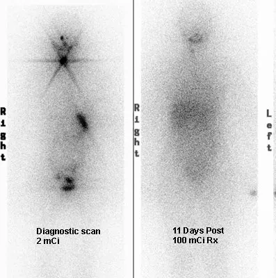 Thyroid Scan: Diagnostic vs. Post-Radioactive Iodine