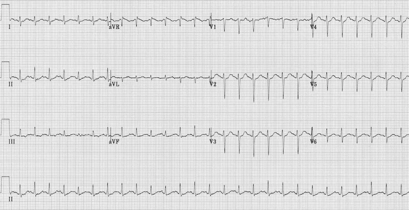 ECG: Atrial Fibrillation in Thyrotoxicosis