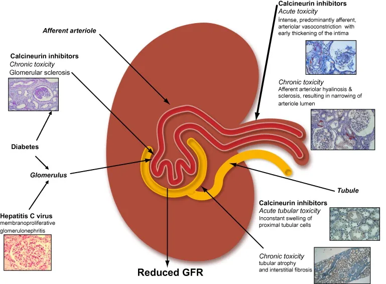 Calcineurin Inhibitor Nephrotoxicity