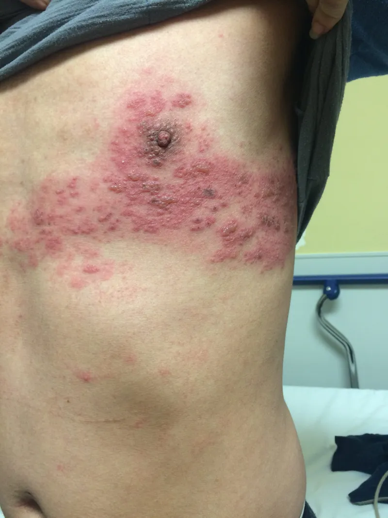 Herpes Zoster Rash on Torso
